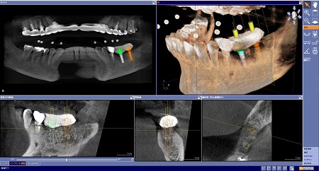 ＣＴによるレントゲン撮影
