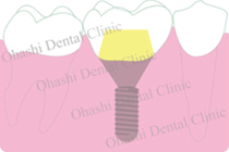 インプラントの画像