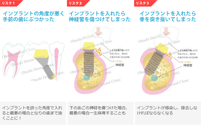 インプラントの失敗例