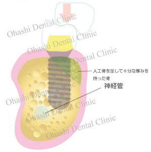 理想的なインプラント