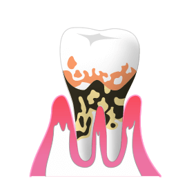 歯周病のイメージ