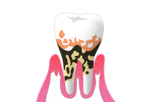 歯周病とは？